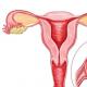 Признаки внематочной яичниковой беременности